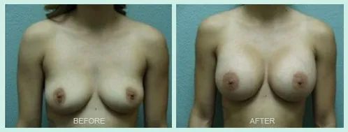Breast Augmentation before and after set 1